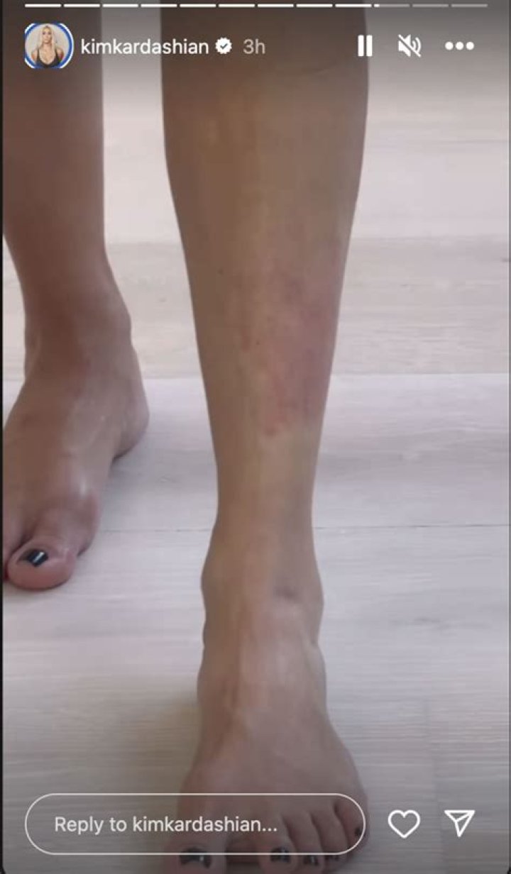 Carefree! Kim Kardashian Shares Video of Her ‘Psoriasis Face’ and It’s Inspiring