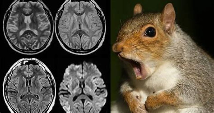 Eating Squirrel Brains May Have Given This Man Mad-Cow-Like Disease