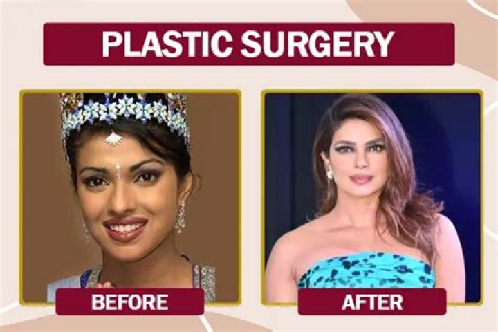 From Bollywood to Hollywood! Has Priyanka Chopra Had Plastic Surgery? See Her Transformation Photos