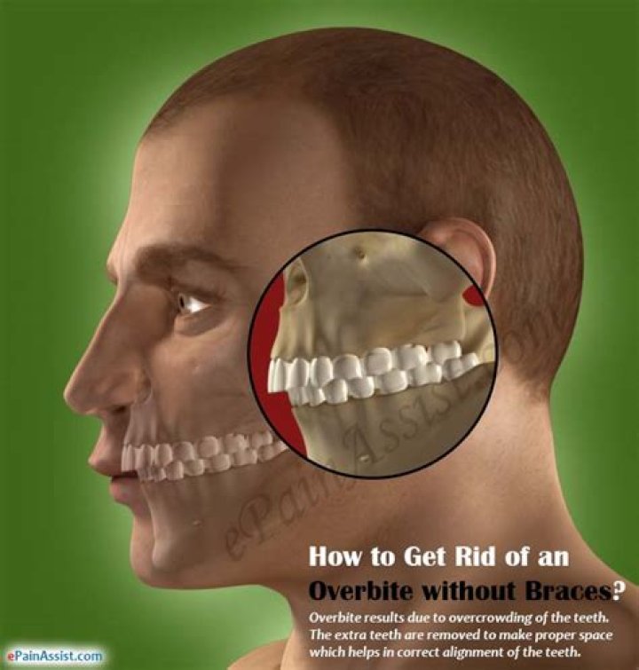 How to get rid of an overbite without braces