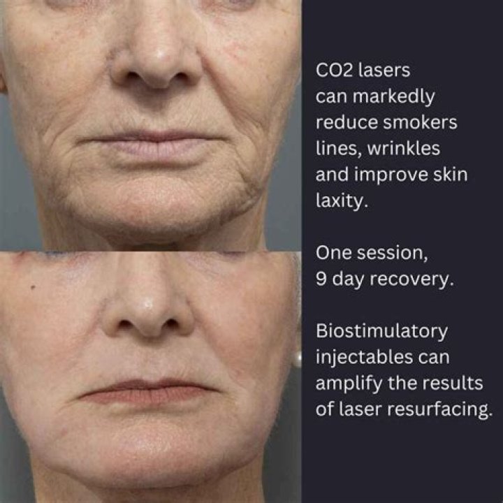 LeAnn Rimes’ Slight Plastic Surgery Tweaks Include Botox and Laser Resurfacing, Experts Say (EXCLUSIVE)