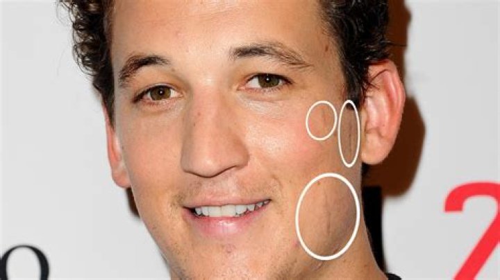 Miles Teller, Charlie Puth, and More Stars You Didn’t Notice Have Scars on Their Faces