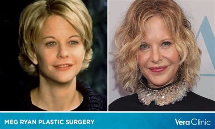 Plastic Surgery?See Meg Ryan’s Shocking Transformation Right Before Your Eyes