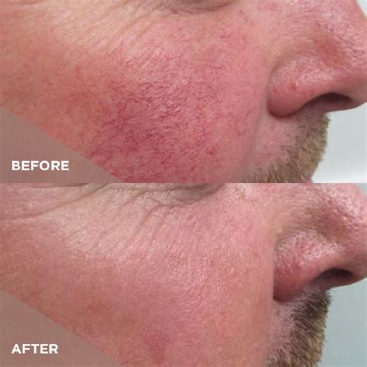 Say Goodbye to Sun-Damaged Skin! LaserAway’s IPL Photofacial Eliminates Brown and Red Discoloration