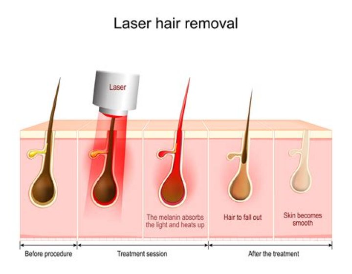 Skin Check-In With Dr. Will: 11 Things You Need to Know Before Getting Laser Hair Removal